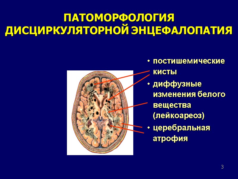 3 ПАТОМОРФОЛОГИЯ ДИСЦИРКУЛЯТОРНОЙ ЭНЦЕФАЛОПАТИЯ постишемические кисты диффузные изменения белого вещества (лейкоареоз) церебральная атрофия